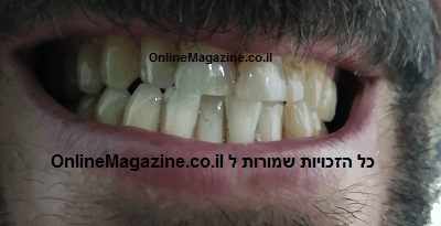 הסרת כתמים בשיניים תמונה לפני צחצוח